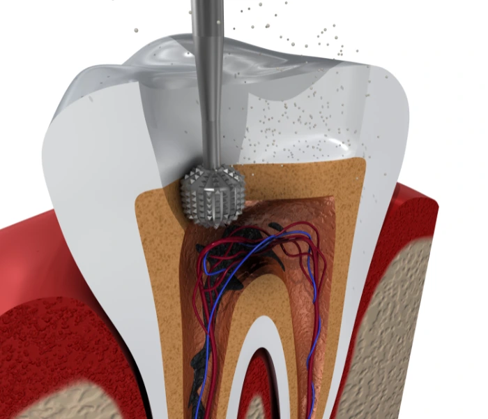 Root canal treatment procedure showing dental drill accessing infected tooth pulp with detailed cross-section anatomy