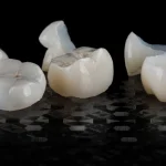 Dental crowns that fell off shown separately from teeth demonstrating crown emergency